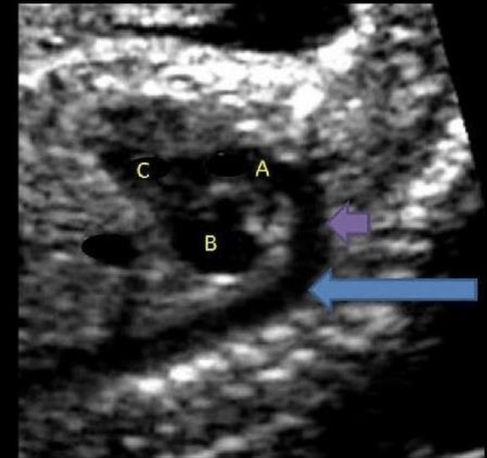 <p>what is letter A</p><p>a) descending AO</p><p>b) ascending AO</p><p>c) main pulmonary artery</p><p>d) aortic arch</p>