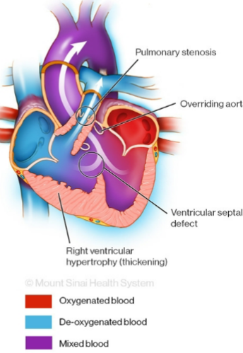 <ol><li><p>Right ventricular hypertrophy</p></li><li><p>Aorta displacement (open to LV and RV)</p></li><li><p>Pulmonary valve stenosis</p></li><li><p>Septal defect (VSD)</p></li></ol><p>“boot shaped heart” on x-ray, child experiences “tet” spells which are relieved by squatting or knee-chest position, needs staged surgeries</p><p></p>