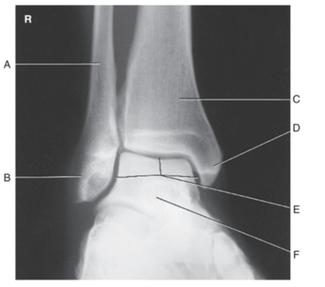 <p>(MORTIS AP ANKLE) what is A?</p>