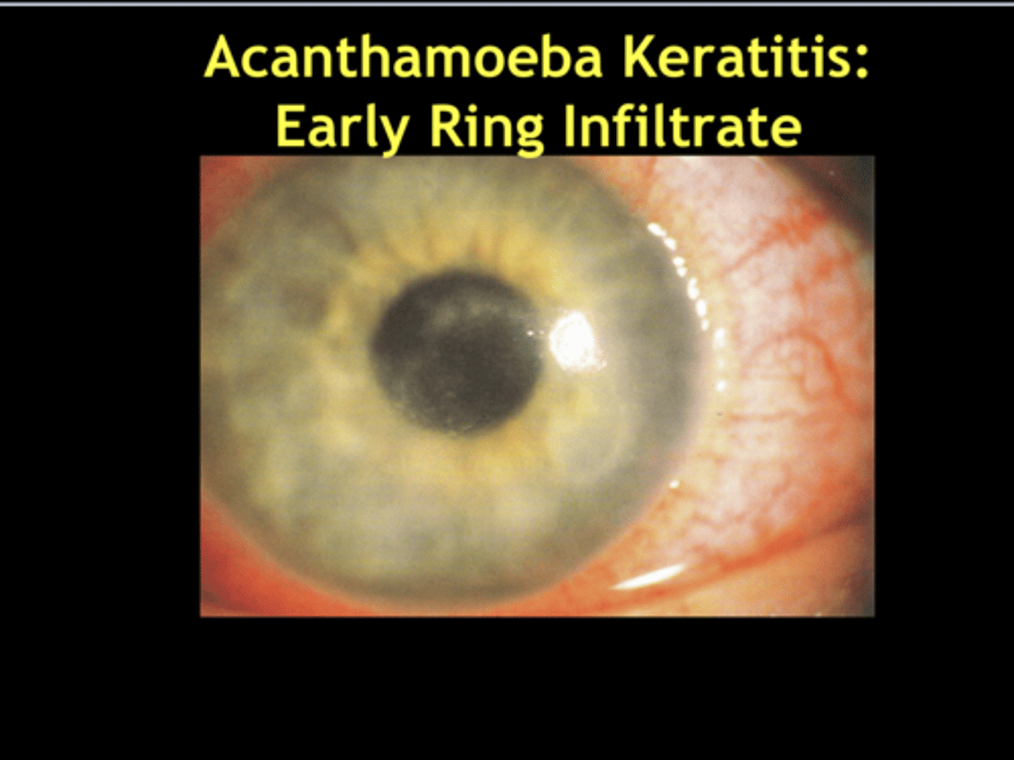<p>Early Acanthamoeba Keratitis (Pic)</p>