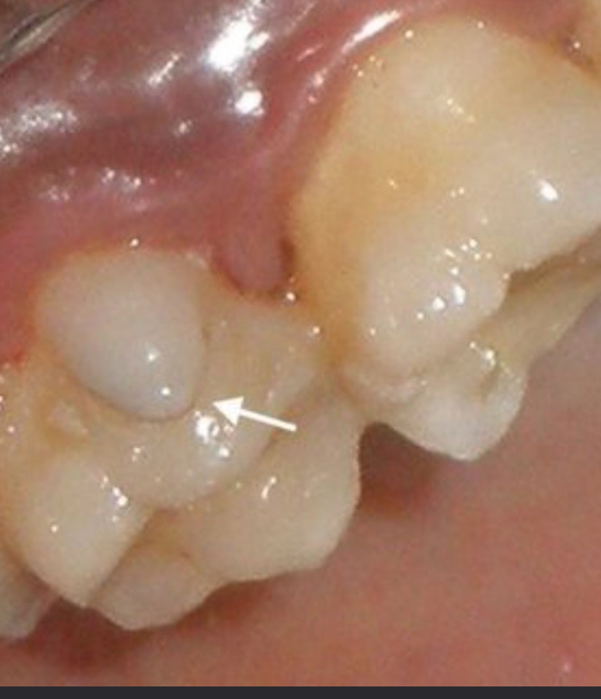 <p>Mostly on mesial linguals of maxillary first molars, a type of tubercle</p>