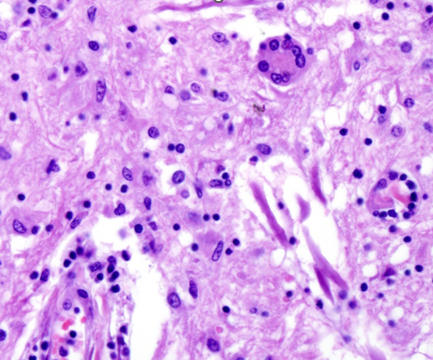 <p>Tissue from a horse.<span>&nbsp;&nbsp; </span>Which of the following is NOT true?</p><ol><li><p class="MsoNormal"><span>&nbsp;</span>Gross lesions in this condition are confined to the CNS.</p></li><li><p>The organism does not form a parasitophorous vacuole in infected cells.</p></li><li><p>Gametogony occurs in the spinal cord and brain in affected horses.</p></li><li><p>Lesions are primarily seen in the brainstem and cervical and thoracic spinal cord.</p></li></ol><p></p>