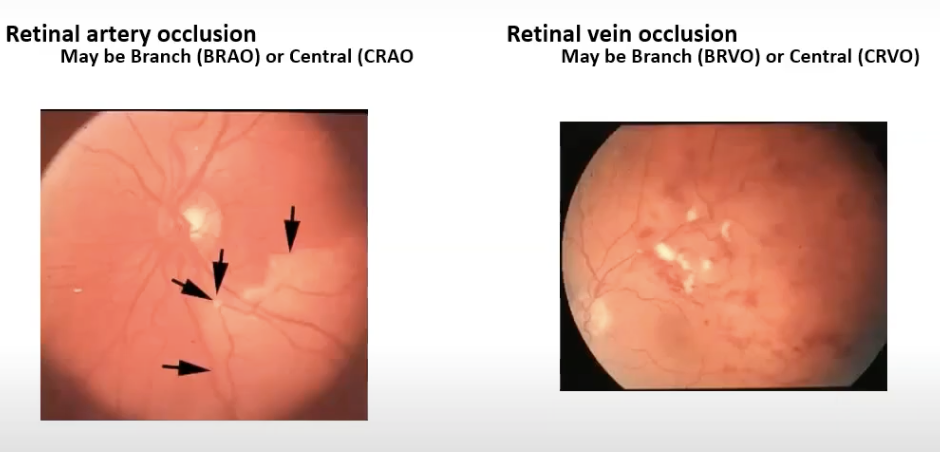 <p>retinal artery occlusoon- more serious due to oxygen stopped from reaching tissue</p><p>retinal vein occlusion</p>
