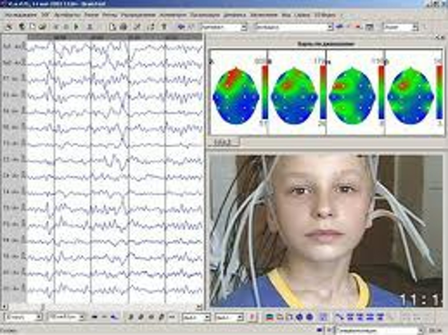 <p>An amplified recording of the waves of electrical activity that sweep across the brain's surface. These waves are measured by electrodes placed on the scalp.</p>