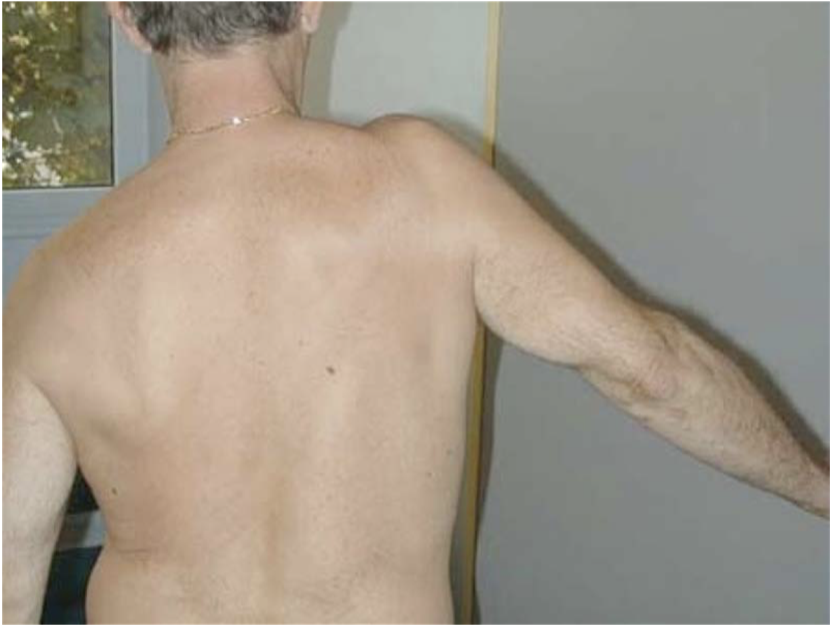 <p>Mise en situation : Mouvement d’abduction globale est diminué avec un mouvement de rotation vers le haut de la ceinture scapulaire complet ou augmenté.</p><p>Faites l’analyse du mouvement + inclure les déficiences possibles</p>