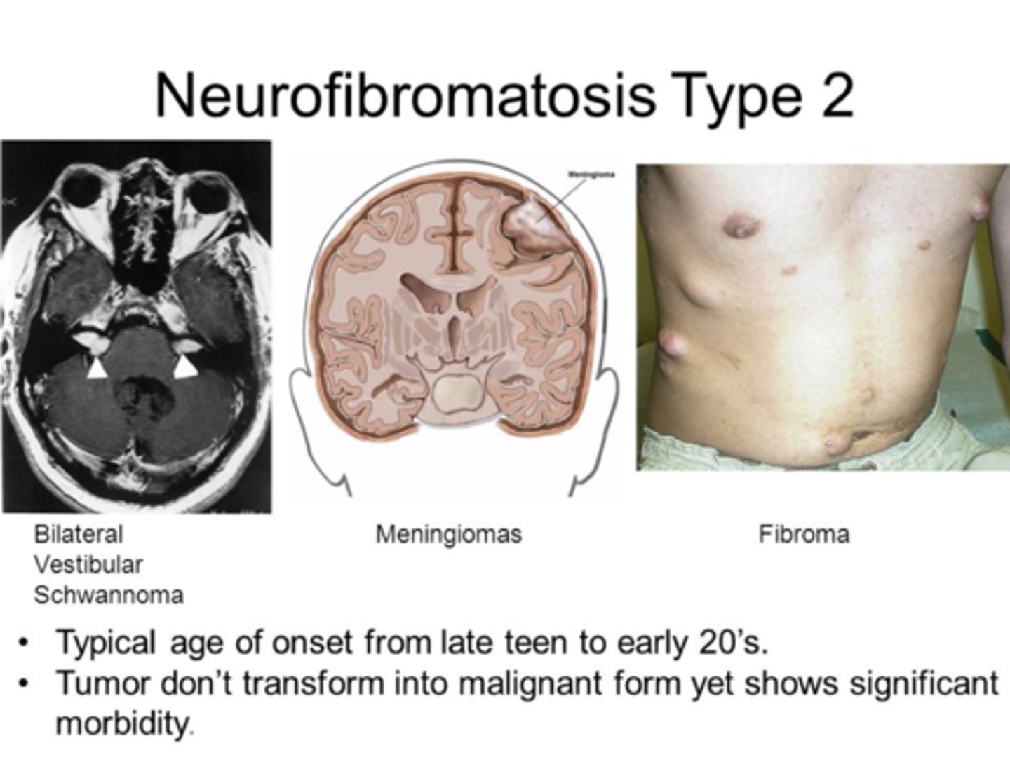 <p>Bilateral vestibular schwannomas are seen in neurofibromatosis type 2, SCHWANN CELLS EXPRESS A GENE CALELD NEUROFIBROMIN 2 ENCODING A PROTEIN CALLED MERLIN WHICH IS A TUMOUR SUPRESSOR GENE) and in neurobromatosis there is deletion on chromosome 22 leading to mutation of in NF2 which inactivates merlin àuncontrollable division</p><p>But majority of tumours (90%) are unilateral </p>