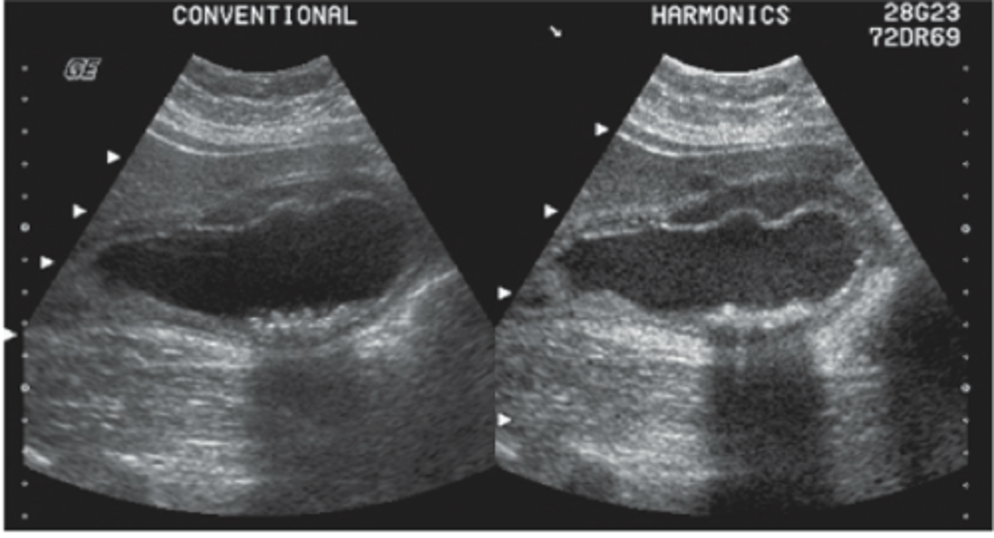<p>- GALLSTONES</p><p>- pericholecystic fluid</p><p>- sludge</p><p>- thickened GB wall</p><p>- distended lumen greater than 4cm</p>