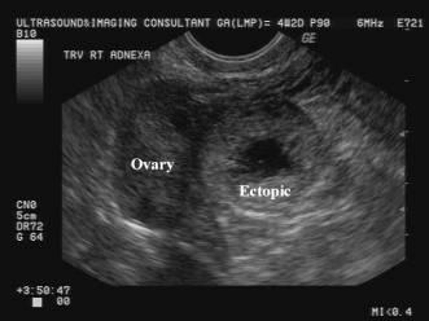 <p>An empty uterus combined with a tubal ring sign (gestational sac outside the uterus).</p>