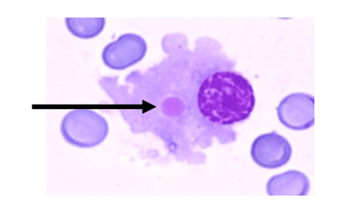 <p>grapelike globular inclusion associated in a Mott cell</p><p>-associated with multiple myeloma</p>
