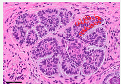 <p><strong>Peripheral palisading</strong><span> of tumor cell nuclei — cells align in a fence-like arrangement around tumor nests.</span></p>