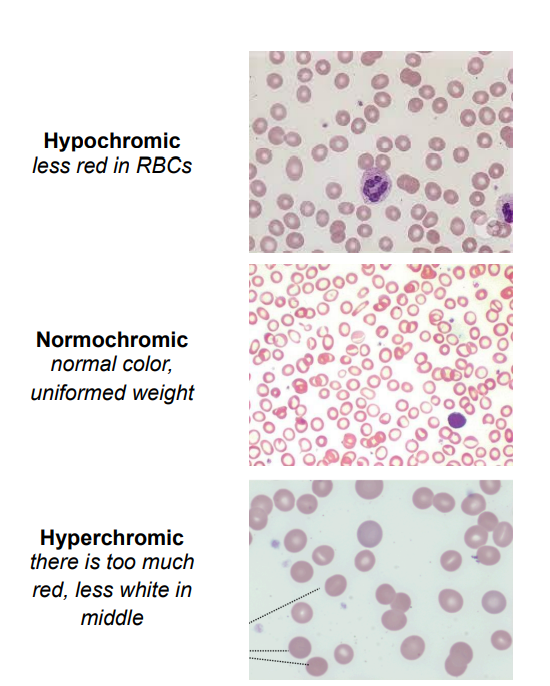 <p><strong>[</strong><span data-name="drop_of_blood" data-type="emoji">🩸</span><span data-name="bar_chart" data-type="emoji">📊</span> <strong>What Blood Laboratory Test?]</strong></p><ul><li><p><span data-name="pushpin" data-type="emoji">📌</span> measures the <strong>amount of hemoglobin per volume of RBCs</strong>.</p></li><li><p class="has-focus">Results</p><ul><li><p class="has-focus"><span data-name="chart_decreasing" data-type="emoji">📉</span> <strong>Hypochromic</strong> – Low hemoglobin concentration.</p></li><li><p><span data-name="check_mark_button" data-type="emoji">✅</span> <strong>Normochromic</strong> – Normal hemoglobin concentration (32 - 36 g/dL).</p></li><li><p><span data-name="red_circle" data-type="emoji">🔴</span> <strong>Hyperchromic</strong> – High hemoglobin concentration, RBCs appear darker with no white center.</p></li></ul></li><li><p class="has-focus">Normal values range from 32-36 grams/dL</p></li></ul><p></p>