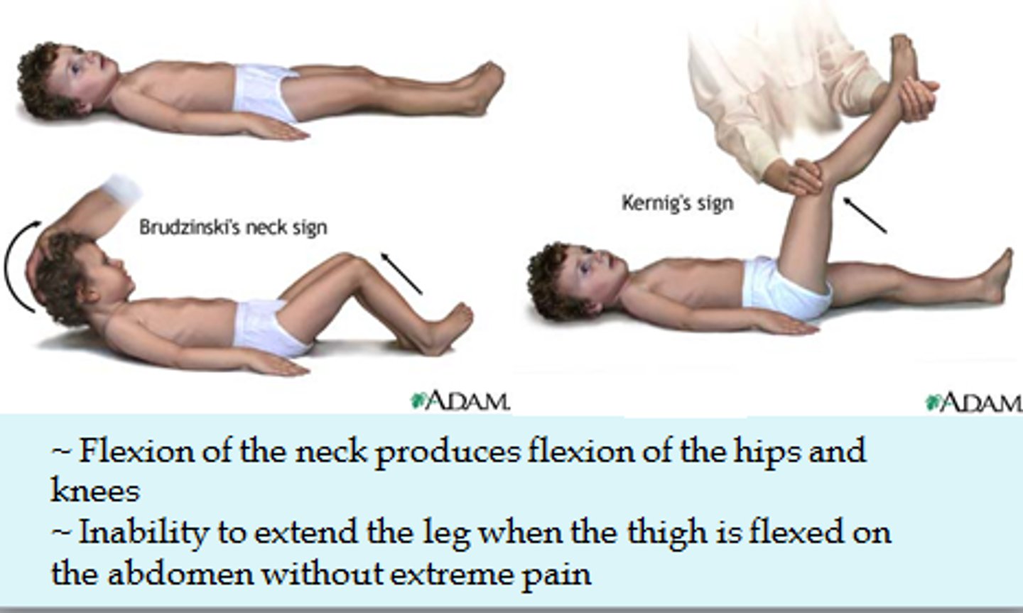 <p>a diagnostic sign for meningitis marked by the person's inability to extend the leg completely when the thigh is flexed upon the abdomen and the person is sitting or lying down</p>