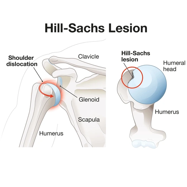<p>hill-sachs lesion, indentation of humerus caused by compression against glenoid rim during the dislocation (humerus head also affected)</p>