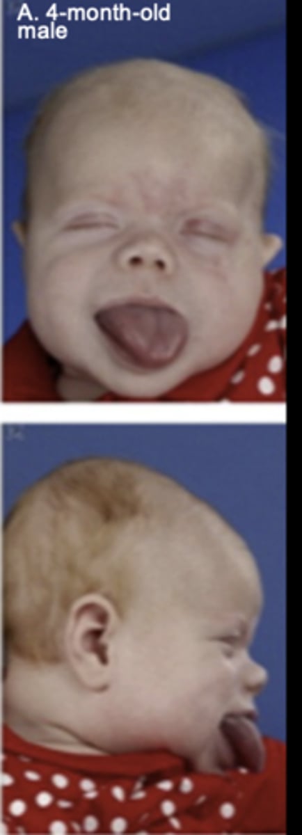 <p>Abnormally large tongue.</p>