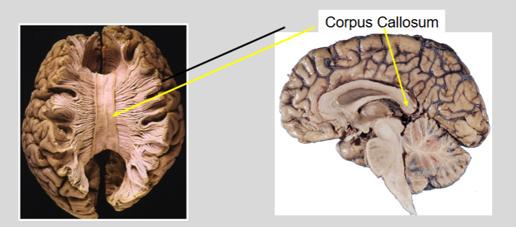 <p>procedure in which the two hemispheres of the brain are isolated by cutting the connecting fibers between them (mainly those of the corpus callosum)</p>