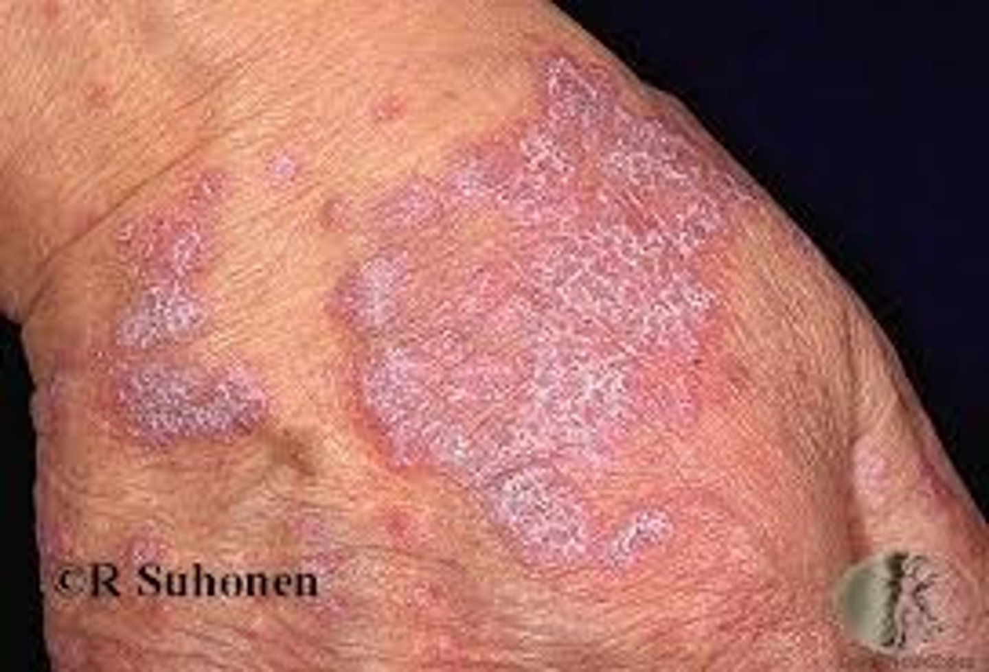 <p>Sawtooth infilitrate of lymphocytes at dermal-epidermal junction</p><p>Hep C association</p>