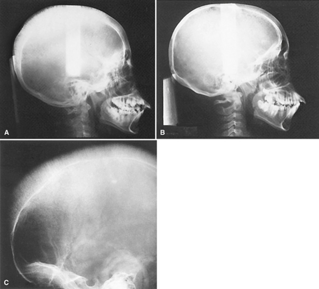 <p>The radiographs show widening o the diploic space (between the inner and outer cortices) and a "hair-on-end" appearance are features of what pathology?</p>