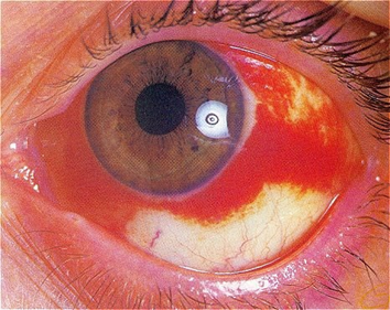 <ul><li><p><span>Arise due to <u>bursting</u> of either the </span><span style="color: blue"><u>episcleral or conjunctival vessels</u>&nbsp;</span></p></li><li><p><span>Blood collects in the <u>subconjunctival space </u>due to </span><span style="color: red"><strong>BV located in <u>inner connective tissue layer</u> of conjunctiva</strong></span></p></li><li><p><span>Associated with<strong> <u>coughing or vomiting - temporary increase in venous pressure = vessel burst</u>&nbsp;</strong></span></p></li><li><p><span>Most commonly found on the<strong> </strong></span><span style="color: green"><strong><u>temporal or inferior conjunctiva</u></strong></span><span> - </span><span style="color: blue"><strong><u>unilateral</u>&nbsp;</strong></span></p></li><li><p><span>Seen in <strong><u>over 50s</u></strong></span></p></li></ul><p></p>