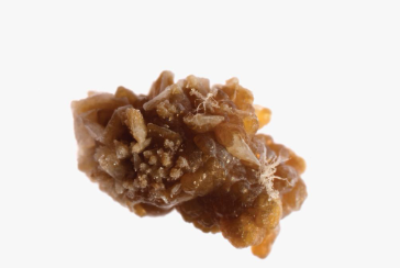 <p>Renal calculus (kidney stones)</p>