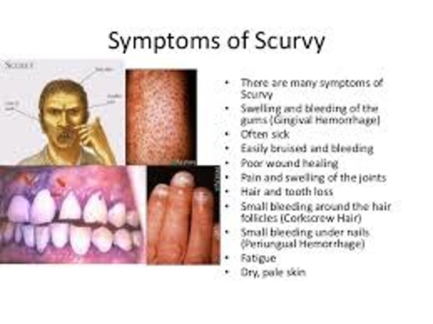 <p>1) Easy bruising</p><p>2) Pinpoint hemorrhages (Petechiae)</p><p>3) Bone fracture / Bone & teeth pain</p><p>4) Bleeding gums</p><p>5) Corkscrew hairs</p>