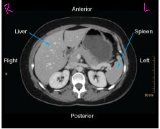 <p>Presented as if the viewer is standing at the foot of the patient’s bed; the patient’s right is to the viewer’s left; the anterior aspect of the patient is toward the top of the image</p>