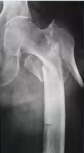 <p>INCIDENCIA Y TRATAMIENTO</p>