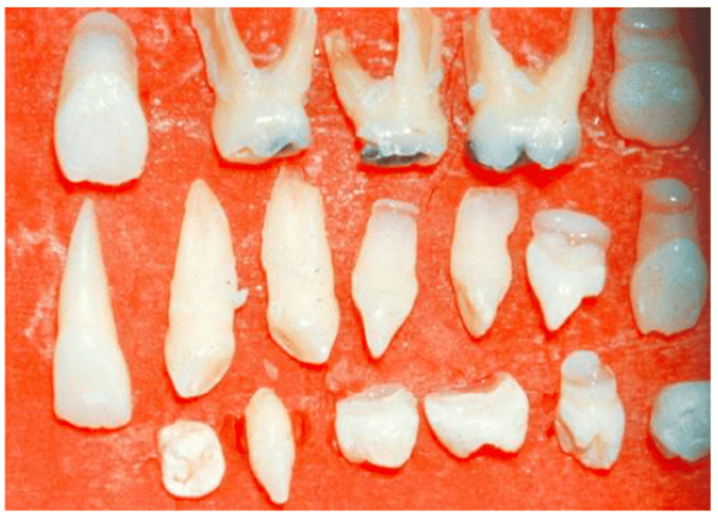 <p>-multiple extracted supernumerary teeth rom the patient with cleidocranial dysplasia</p><p>-results in cranium developing into a mushroom shape because the fontanelles remain open</p><p>-the premaxilla is generally underdeveloped</p>