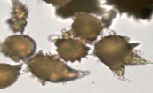 <p>Normal </p><ul><li><p>alkaline urine</p></li><li><p>soluble in acetic acid, heat</p><ul><li><p>acetic acid turns crystals into uric acid crystal</p></li></ul></li><li><p>Usually an artifact of old or improperly stored urine</p></li><li><p>If in fresh urine → clinically significant</p></li><li><p>Thorny apple, brown</p></li></ul><p></p>