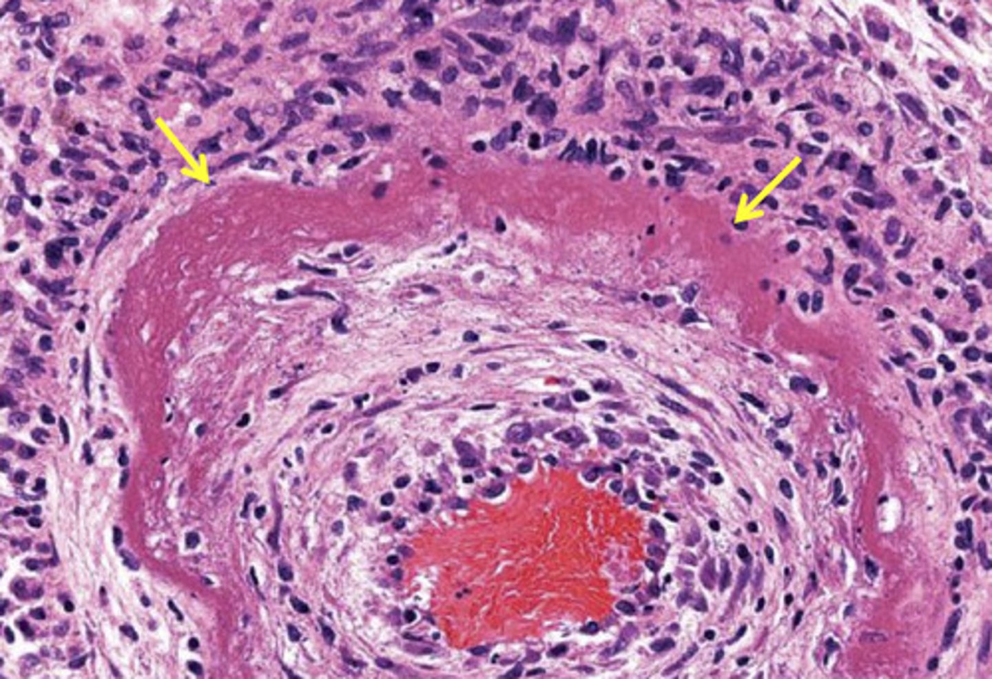 <p>Fibrinoid necrosis </p>