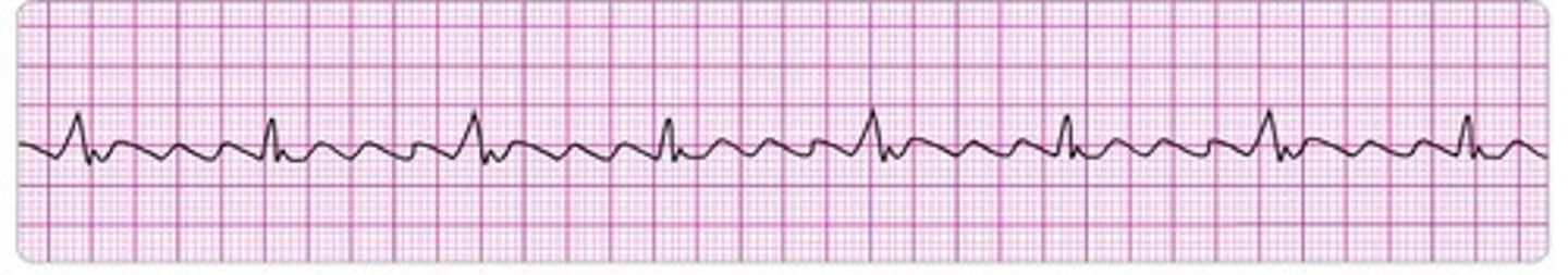 <p>what rhythm is this?</p><p>known as the saw tooth strip</p><p>Atrial rate is increased - can be regular or irregular</p><p>P waves: fluttering, have more than one (they are all the same)</p><p>PR is variable, can be WNL 0.12-0.2 normal</p><p>QRS: 0.04-0.12-normal</p><p>QT: 0.4-0.44 seconds normal</p><p>TX: calcium channel blockers, diltelizem, cardioversion</p>