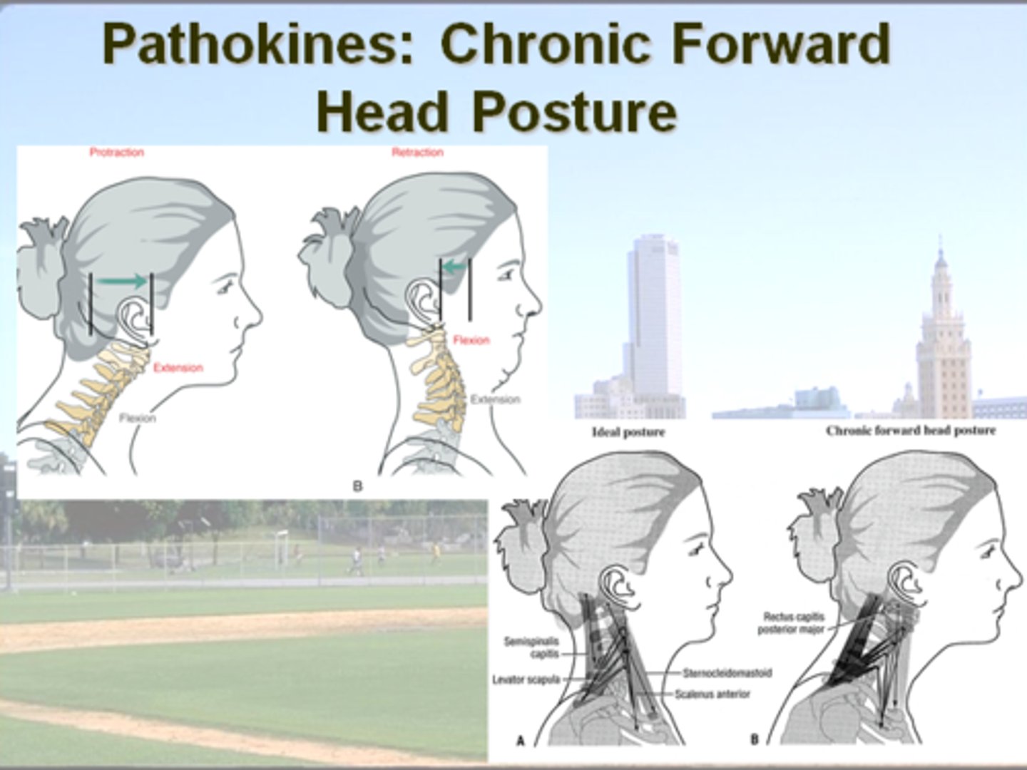 <p>upper C-spine = extension</p><p>vs.</p><p>Mid &amp; Lower C-spine = flexion</p><p>increases stress on :</p><p>- levator scapulae</p><p>- semispinalis capitis</p><p>+</p><p>shortens SCMs</p>