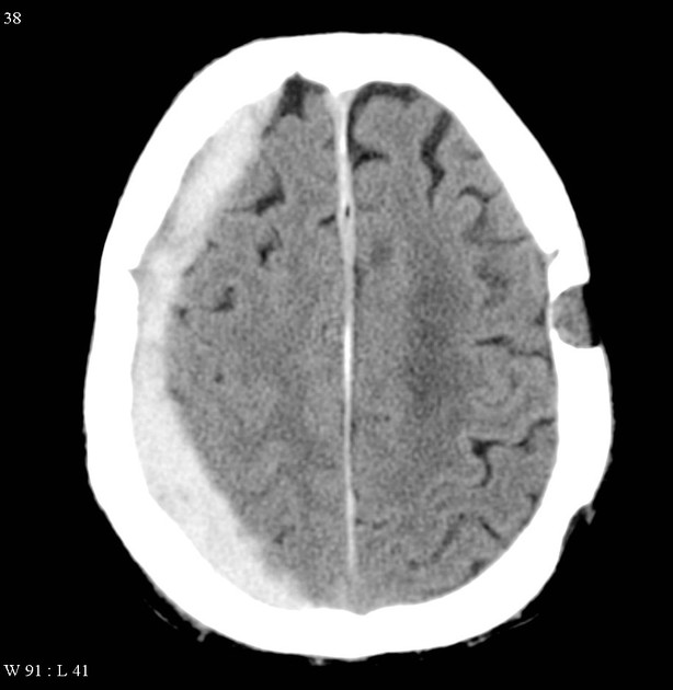 <ul><li><p>collection of blood in the potential space between the arachnoid mater and the dura mater </p></li><li><p>crescent shaped appearance on the CT </p></li><li><p>acute = high morbidity and mortality </p></li><li><p>often associated with cerebral contusion and edema </p></li></ul><p></p>