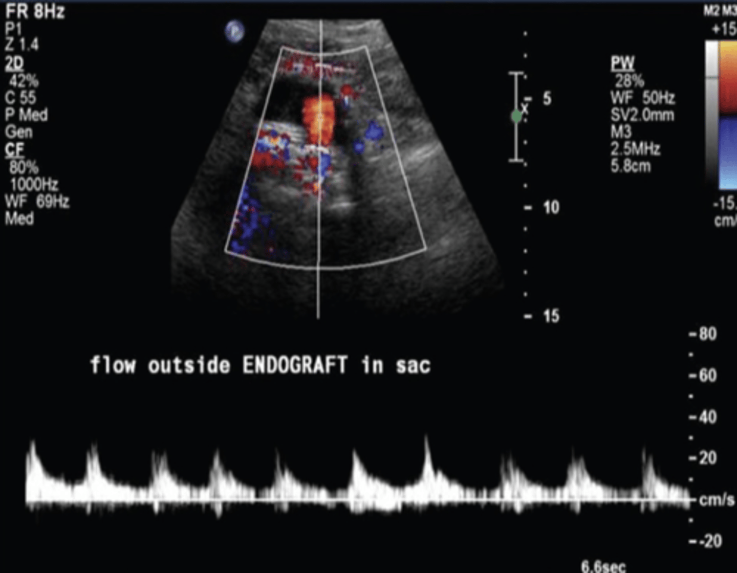 <p>Arterial waveforms are different from flow within endograft</p>