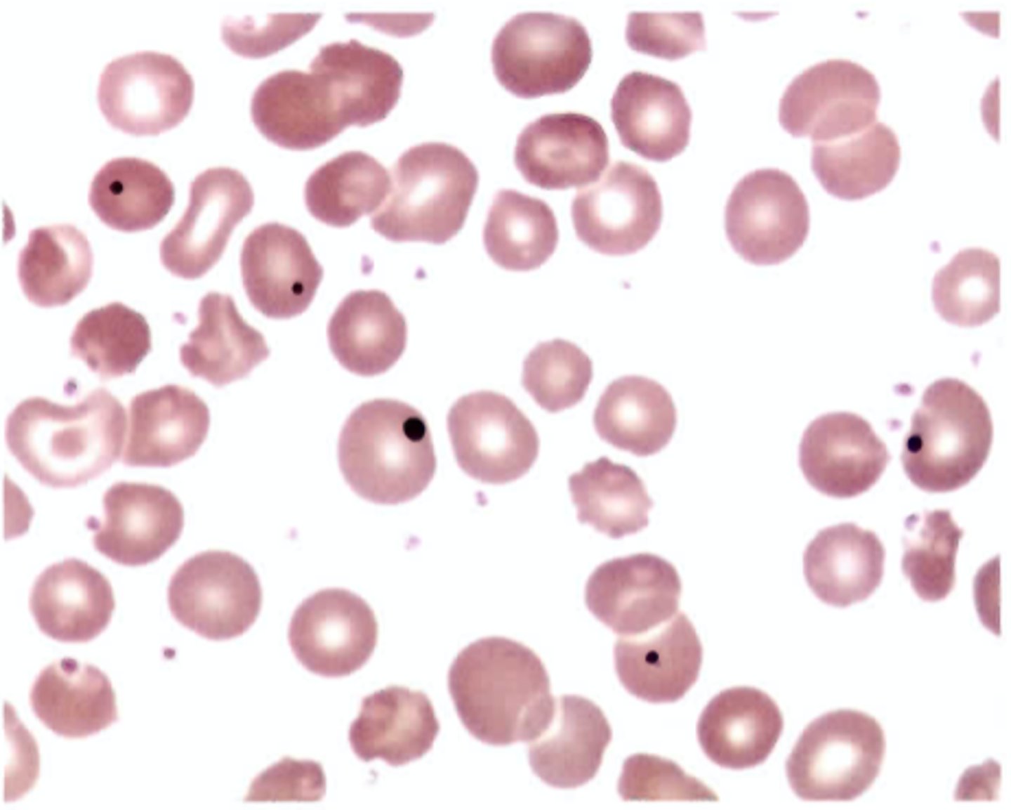 <p>C. Post-splenectomy</p>