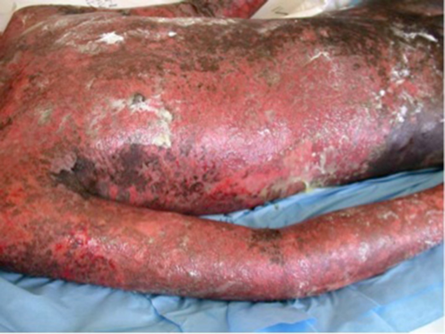 <p>Toxic epidermal necrolysis</p>