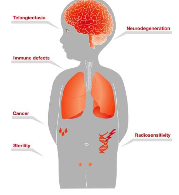 <p>neurodegeneration, immunodeficiency, increased risk of lymphoid malignancies (due to DNA damage signalling pathways inhibited) and interstitial lung disease</p>