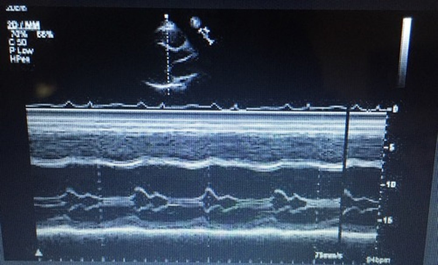 <p>narrowing of the AoV orifice; band of bright echoes on 2-D and M-Mode</p>