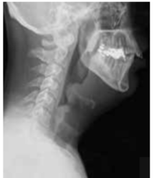 <p>Thumb sign seen in</p>