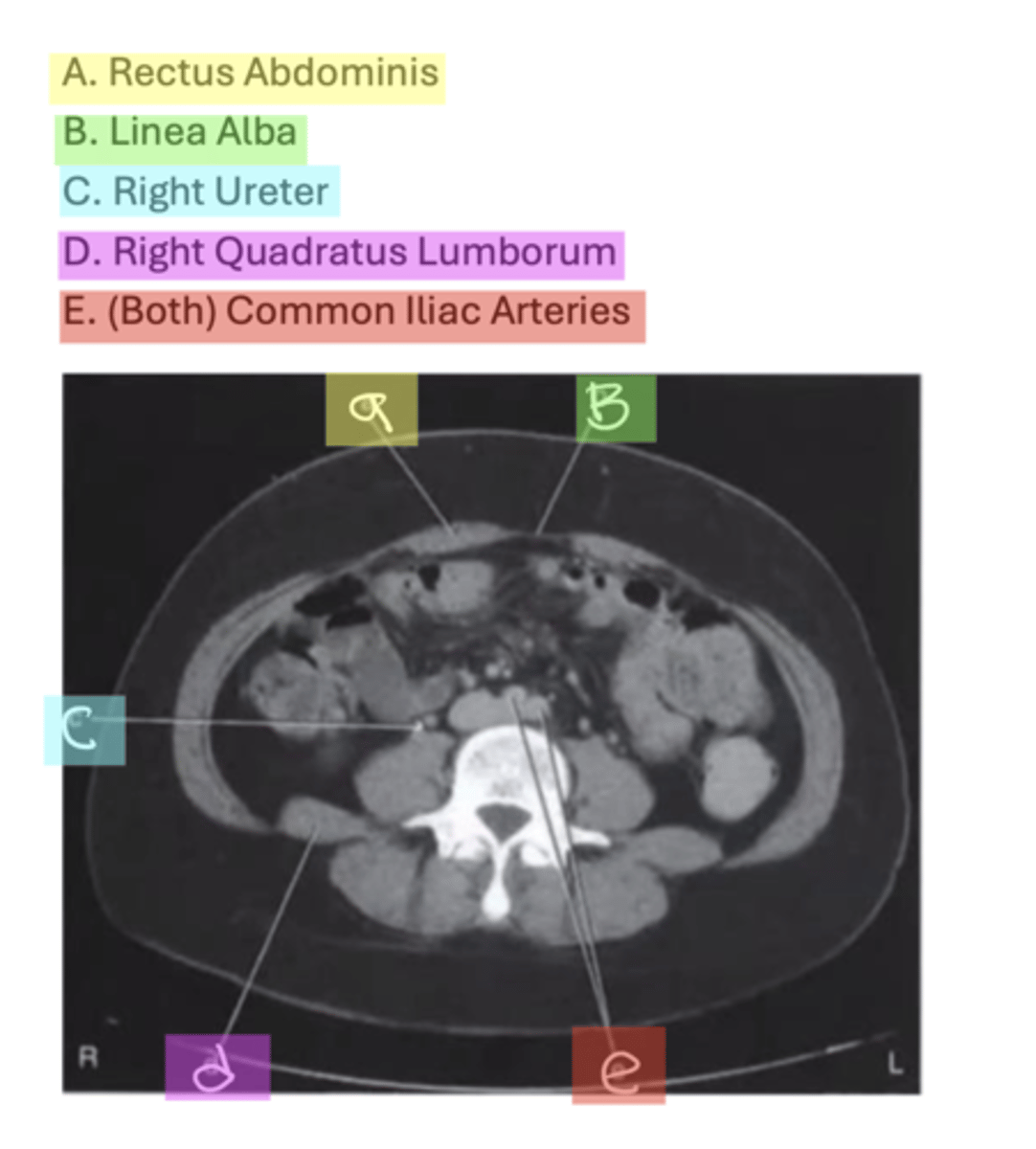 <p>A. Rectus Abdominis</p><p>B. Linea Alba</p><p>C. Right Ureter</p><p>D. Right Quadratus Lumborum</p><p>E. (Both) Common Iliac Arteries</p>