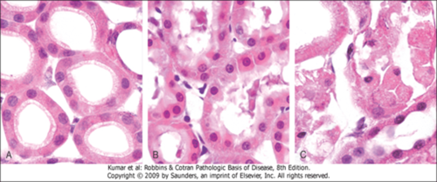 <p>A. Normal kidney tubules with viable epithelial cells.</p><p>B. Early (reversible) ischemic injury showing surface blebs, increased eosinophilia of cytoplasm, and swelling of occasional cells.</p><p>C. Necrosis (irreversible injury) of epithelial cells, with loss of nuclei, fragmentation of cells, and leakage of contents.</p>