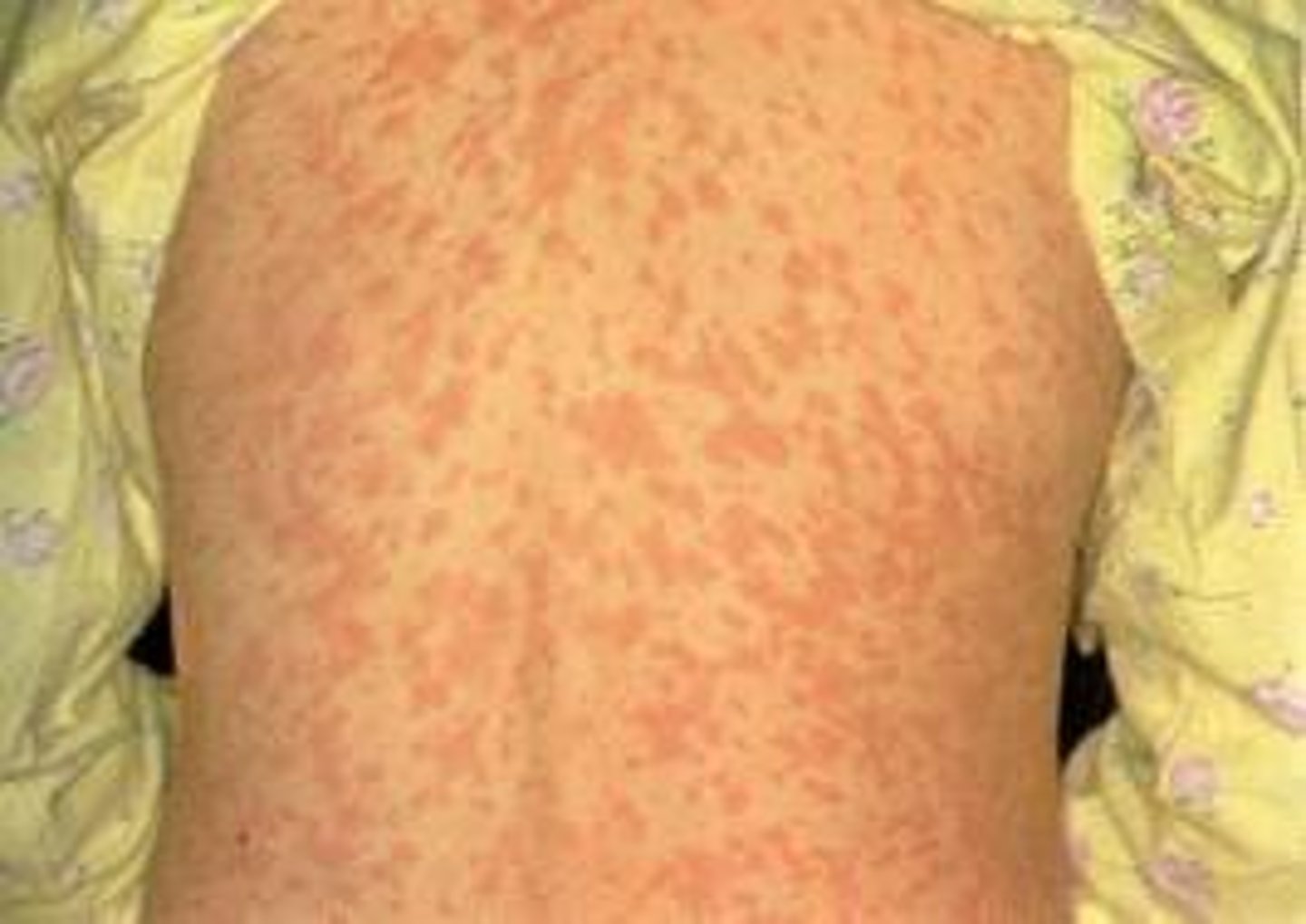 <p>A rash that appears 1-3 days later to initial symptoms and is caused by a T-cell response to infected capillary endothelial cells</p><p>macule: flat red spots</p><p>papule: small, raised bumps</p>
