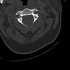 <p>fracture of C2 arch with subluxation of C2-C3.</p>