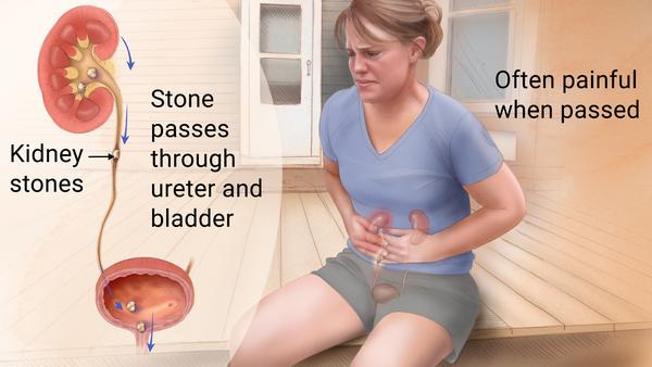 <p><strong>A client has been diagnosed with having calcium oxalate kidney stones following intravenous pyelography. Which of the following teaching points about the treatment of the health problem are justifiable? Select all that apply.</strong></p><p>A) “You may need to cut out cocoa, chocolate, and some nuts from your diet.”</p><p>B) “It's important that you avoid high-calcium foods like milk, cheese, and yogurt.”</p><p>C) “We will come up with a plan to safely limit your fluid intake over the next few</p><p>weeks.”</p><p>D) “Extracorporeal shock-wave lithotripsy treatment may be used to fragment larger stones.”</p><p>E) “Most likely your stones can be dissolved by medications over the next several days.”</p>