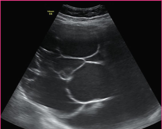 <p>Mucinous cystadenocarcinoma is found in _____ women between the ages ___-____</p>