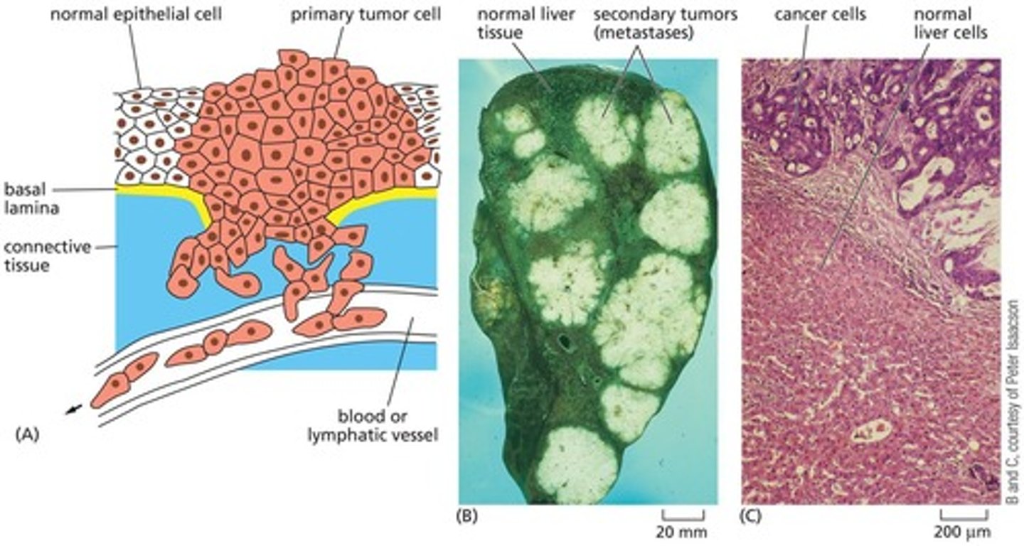 <p>Cancerous cells are malignant and have invaded surrounding tissues, often breaking through the basal lamina.</p>