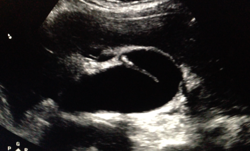 <p><span style="color: yellow;">folding of GB fundus</span></p>