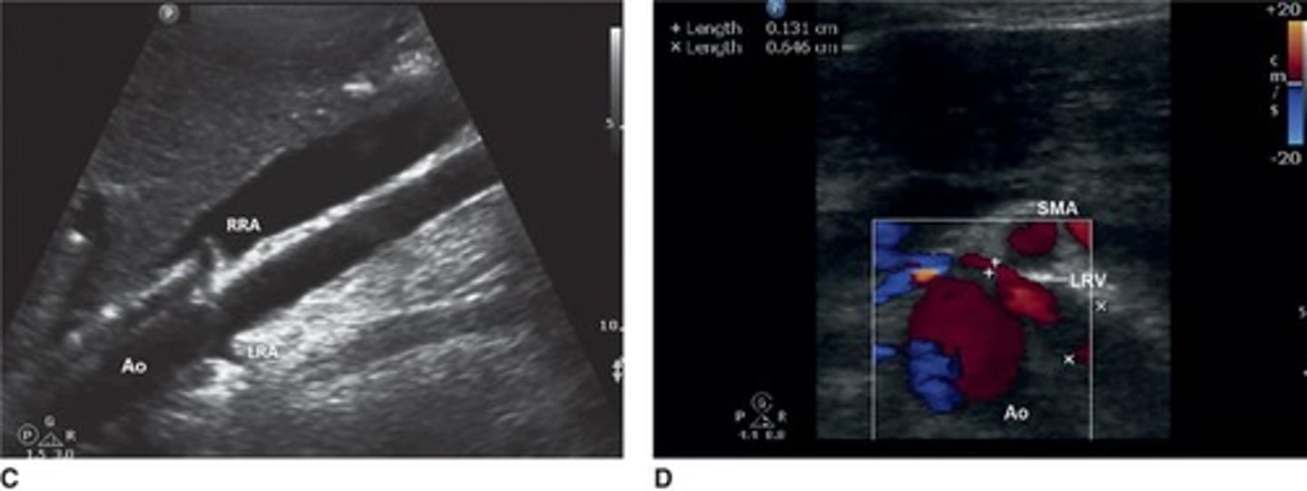 <p>Compression of the left renal vein between the superior mesenteric artery and the aorta.</p>
