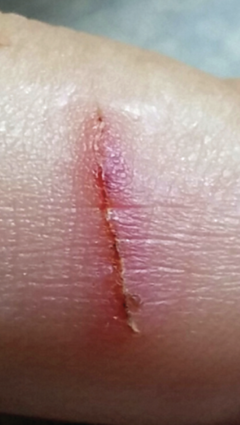 what type of skin wound?