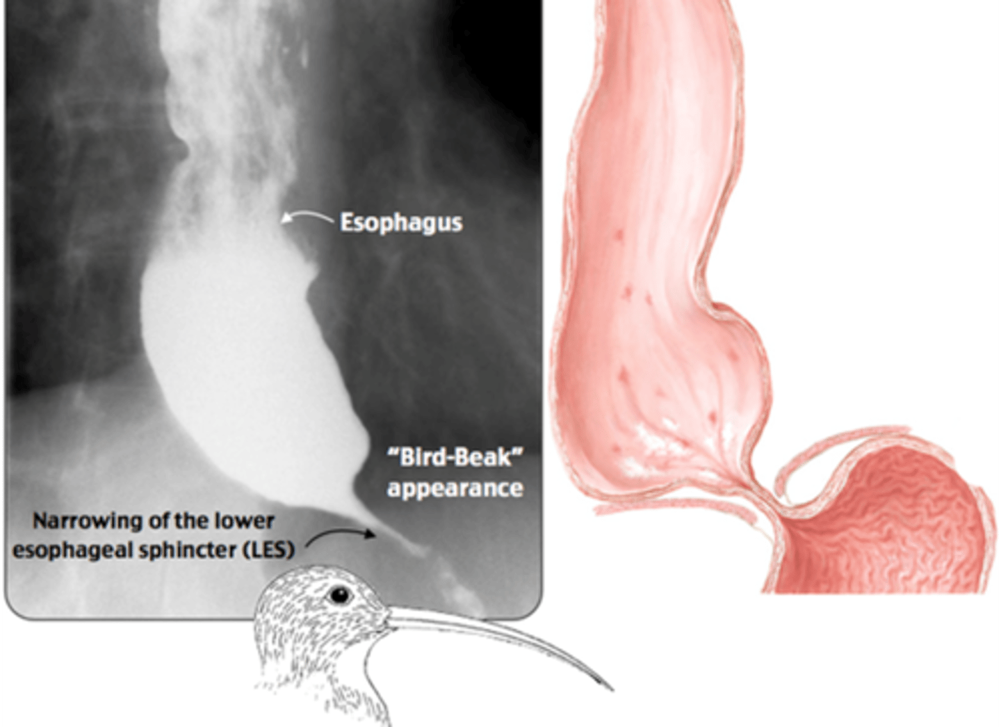 <p>- shows motility abnormalities, hiatal hernia, esophageal stricture</p><p>-not helpful in diagnosing GERD with no esophageal damage</p><p>[use amb pH monitoring]</p>