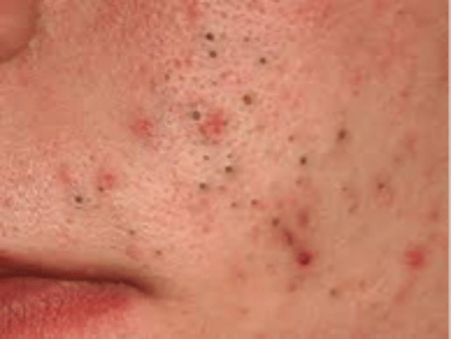 <p>The plugged opening of a sebaceous gland at pore/follicle</p><p>- Ex: Acne</p><p>- White (closed)</p><p>- Black (open)</p>